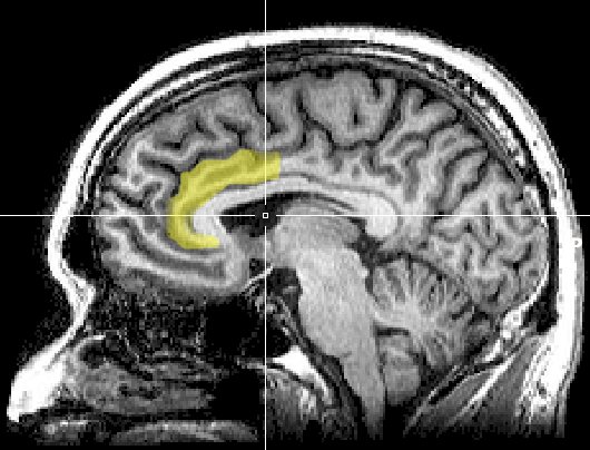 MRI_anterior_cingulate